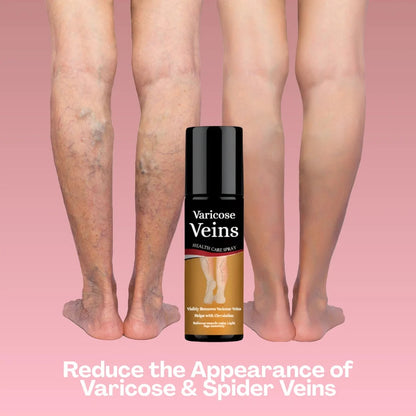Varicose Vein Spray Leg Pain Gone, Confidence On