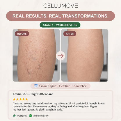 VARICOSE VEINS