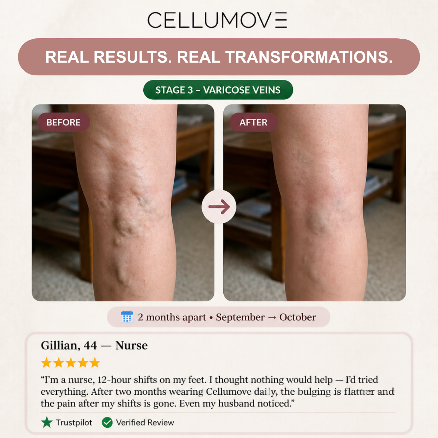 VARICOSE VEINS