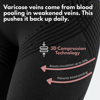 VARICOSE VEINS