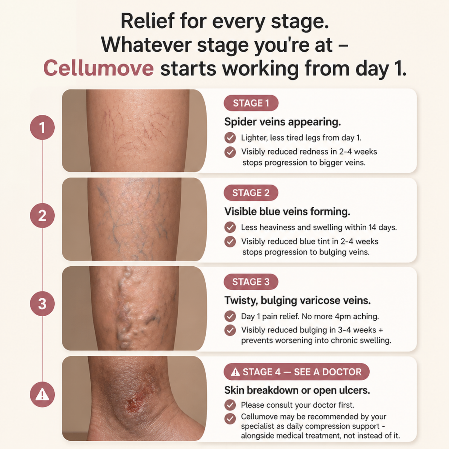 VARICOSE VEINS